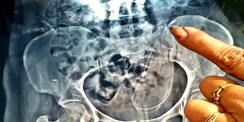 அறுவை சிகிச்சை செய்துகொண்ட பெண்ணின் வயிற்றில் மர்மப் பொருள் இருப்பதாக புகார்