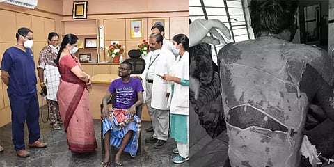 முழுவதும் உரிந்த தோல்.. அரிய வகை நோய் பாதித்த நபரை குணப்படுத்திய கோவை அரசு மருத்துவர்கள்!