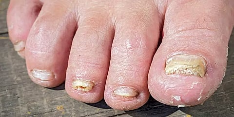 கால் நகங்கள் நிறம் மாறுகிறதா? - கவனம் செலுத்துங்கள்! தொற்றாக இருக்கலாம்