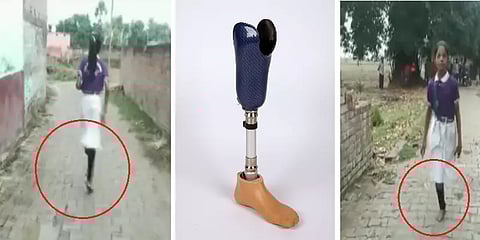 ஒற்றைக்காலுடன் 2 கி.மீ-க்கு குதித்தபடியே தினமும் பள்ளி செல்லும் மாற்றுத்திறனாளி மாணவி