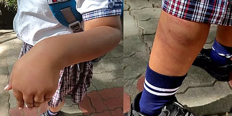 ’வீட்டுபாடம் எழுதலன்னா இப்படியா அடிப்பீங்க’ - மாணவியை அடித்ததாக ஆசிரியை மீது புகார்