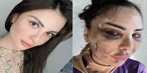 ரியாலிட்டி ஷோ ஸ்டாரை போல மாற ரூ.4 கோடி செலவிட்ட பிரேசில் அழகிக்கு நேர்ந்த கொடுமை!