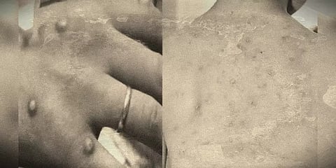 இந்தியாவில் நுழைந்தது குரங்கு அம்மை - கேரளாவில் ஒருவருக்கு உறுதி