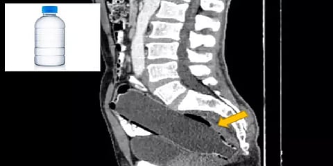 ஆசன வாய் வழியாக சிக்கிய வாட்டர் பாட்டில்.. ஈரானியரின் விபரீதமான விளையாட்டு.. என்ன ஆனது?