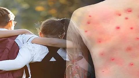 குரங்கம்மை