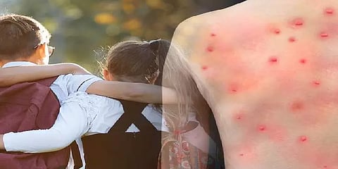 குரங்கம்மை அச்சம்: உடலுறவு கொள்வதை தவிர்க்கவும் - எச்சரிக்கும் உலக சுகாதார அமைப்பு!