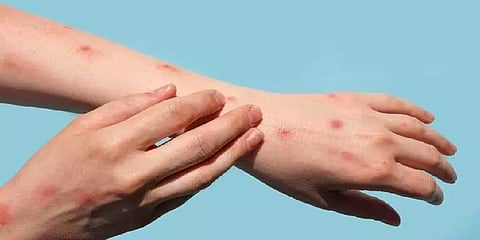 முழுவதுமாக குணமடைந்தார் முதல் குரங்கம்மை தொற்று பாதித்த நபர்.. இன்று வீடு திரும்புகிறார்!