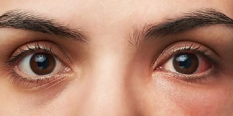 கண்கள் முக்கியம் - மழைக்காலங்களில் அதிகரிக்கும் விழி வெண்படல அழற்சி..!