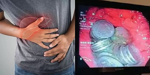 கடும் மன உளைச்சல்! 63 நாணயங்களை விழுங்கிய ராஜஸ்தான் வாலிபர்- மருத்துவர்கள் அதிர்ச்சி