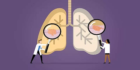 சிகரெட் பிடிப்பதை நிறுத்த ஓர் சிறந்த வழி இதுவே: உலக நுரையீரல் புற்றுநோய் நாள் 2022