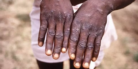 குரங்கு அம்மை தொற்று வராமல் தடுப்பது எப்படி? தொற்று ஏற்பட்டால் என்ன செய்வது?