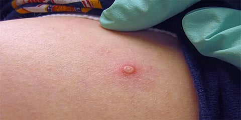 குரங்கம்மை அறிகுறி தெரிந்தால் பொதுநிகழ்ச்சிகளில் கலந்து கொள்ள வேண்டாம் - மத்திய அரசு