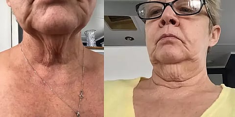 இரட்டை தாடையை நீக்கப்போய் லண்டன் பெண்ணுக்கு கிடைத்த பல்லி போன்ற கழுத்து: நடந்தது என்ன?