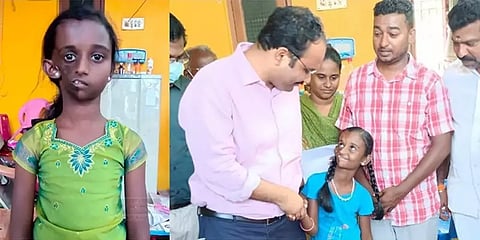 ”முக சிதைவு நோயால் பாதிக்கப்பட்ட சிறுமிக்கு சென்னையில் சிகிச்சை” - திருவள்ளூர் கலெக்டர்!