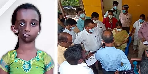 முக சிதைவு நோயால் பாதிக்கப்பட்ட சிறுமி டான்யாவுக்கு வரும் திங்கள்கிழமை அறுவைச் சிகிச்சை!