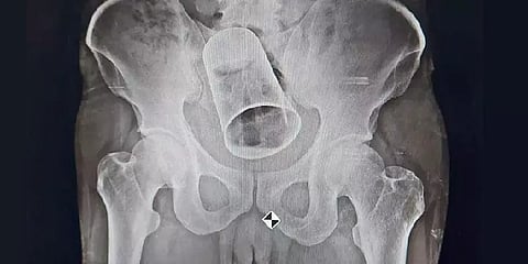 தலைக்கேறிய போதை.. ஆசனவாயிலில் சில்வர் தம்ளரை சொருகிய நண்பர்களால் நிகழ்ந்த விபரீதம்!