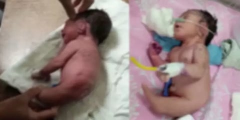 ம.பி: கால்களுக்கு பதிலாக கொம்பு உருவத்துடன் பிறந்த குழந்தை! குழப்பத்தில் மருத்துவர்கள்!