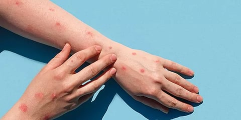 குரங்கம்மை தொற்றால் பாதிக்கப்பட்டவர்களுக்கு இதய நோய்கள் வருகிறதா? - ஆய்வில் தகவல்