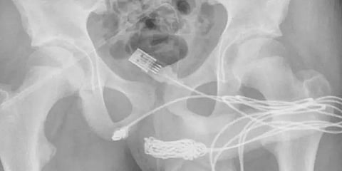 ஆணுறுப்பை அளக்க முயன்ற டீனேஜ் பையனுக்கு நேர்ந்த பரிதாபம்.. லண்டனில் நடந்த விநோத சம்பவம்!