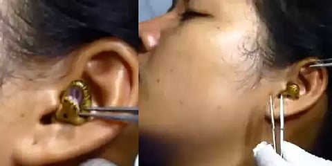 ஷாக்கிங் வீடியோ: பெண்ணின் காதுக்குள் புகுந்த பாம்பு.. திக் திக் நிமிடங்கள்!