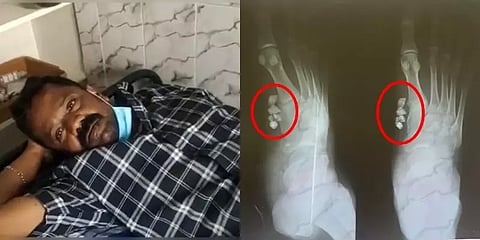 கல் துகள்களை அகற்றாமல் தையல்... அறந்தாங்கி அரசு மருத்துவமனையில் நடந்த அவலம்