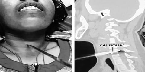 பெண்ணின் கழுத்தில் பாய்ந்த கம்பி – வெற்றிகரமாக அகற்றிய கோவை அரசு மருத்துவர்கள்!