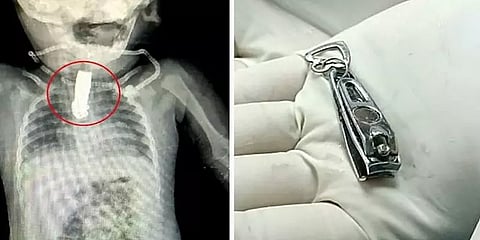 8 மாதக்குழந்தை தொண்டையில் சிக்கிய நெயில் கட்டர் - அறுவைசிகிச்சையில் போராடிய மருத்துவர்கள்!