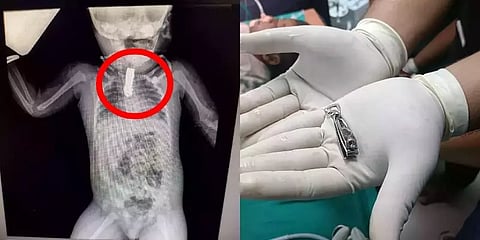 8 மாதக் குழந்தையின் தொண்டையில் சிக்கிய நகவெட்டி - வெற்றிகரமாக அகற்றிய மருத்துவர்கள்!