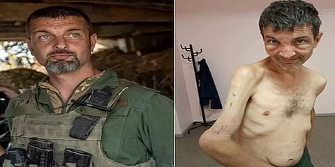 போர்க்கைதியின் நிலை!! வைரலாகும் ரஷ்யாவிடமிருந்து தப்பித்து வந்த உக்ரைன் வீரரின் போட்டோ!