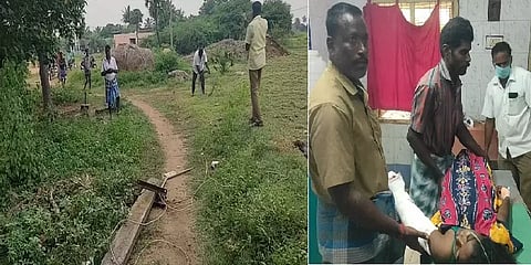 விளையாடிக்கொண்டிருந்த சிறுமி மீது மின்கம்பம் விழுந்ததில் விபரீதம் - கை சிதைந்து சிகிச்சை!