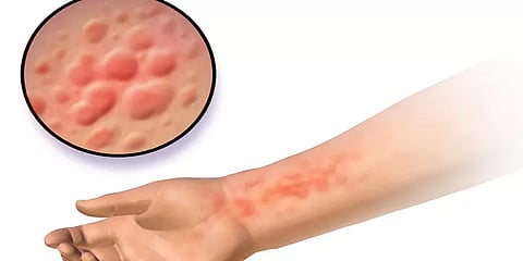 நாள்பட்ட ஒவ்வாமை கட்டுப்படுத்த முடியவில்லையா? இந்த சில உணவு முறைகள் உங்களுக்கு உதவும்!