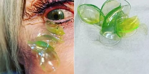 என்ன வந்துகிட்டே இருக்கு! பெண்ணின் கண்ணுக்குள் இருந்து 23 லென்ஸ்கள் அகற்றம் - வைரல் வீடியோ