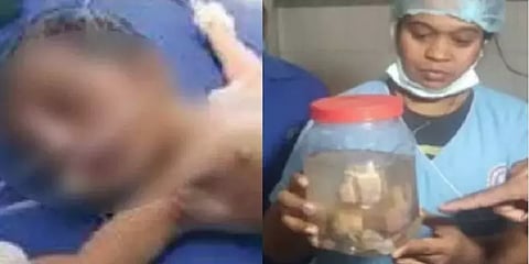 உலகிலேயே அரிய நிகழ்வு - பிறந்த குழந்தையின் வயிற்றுக்குள் 8 கருக்கள் -ஜார்க்கண்டில் அதிசயம்