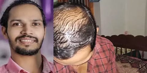 ”என் சாவுக்கு டாக்டர்தான் காரணம்” - முடி உதிர்தலால் விரக்தியடைந்த இளைஞர் விபரீத முடிவு