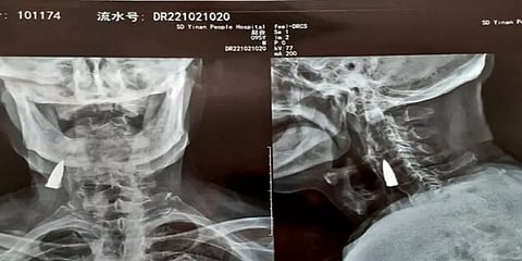 கழுத்தில் தோட்டாவோடு 80 ஆண்டுகளை கழித்த ராணுவ வீரர்.. ஷாக்கான டாக்டர்ஸ்.. பின்னணி என்ன?