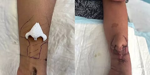 முதன்முறையாக கையில் வளர்ந்த மூக்கு... 3டி பிரிண்டிங் டெக்னாலஜியில் இதுவும் சாத்தியமா?