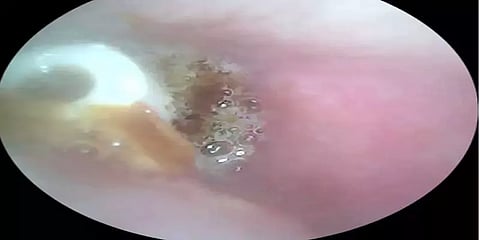 ’earbud’-ஆல் பாதித்த செவித்திறன்.. பிரிட்டிஷ் முதியவரின் 5 ஆண்டு சோகம்.. என்ன நடந்தது?