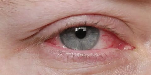 வேகமாக பரவும் மெட்ராஸ்-ஐ.. அலட்சியமாக விட்டால் கண்பார்வையை இழக்க நேரிடும்! எச்சரிக்கை!