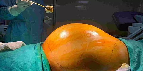 53 வயது நபரின் சிறுநீரகத்தில் கால்பந்து சைஸ் கட்டி - வெற்றிகரமாக அகற்றிய மருத்துவர்கள்