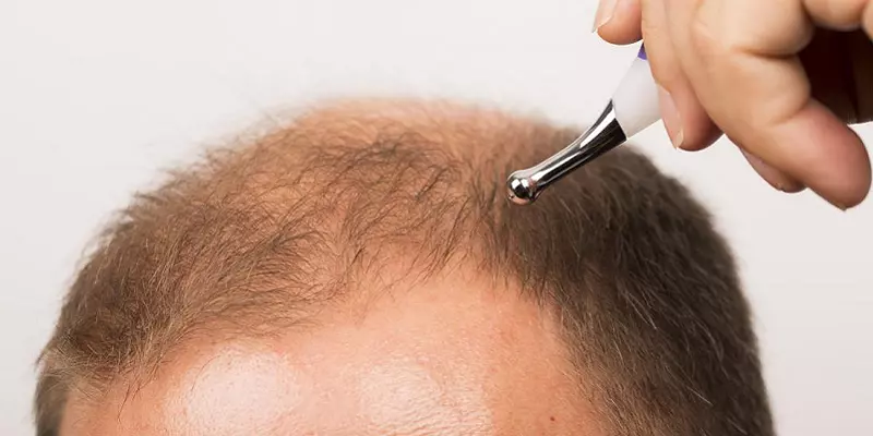 ”இருந்த கொஞ்ச தலைமுடியும் போச்சே!” - ஏமாற்றிய காஸ்மெடிக் மருத்துவமனைக்கு அபராதம்!