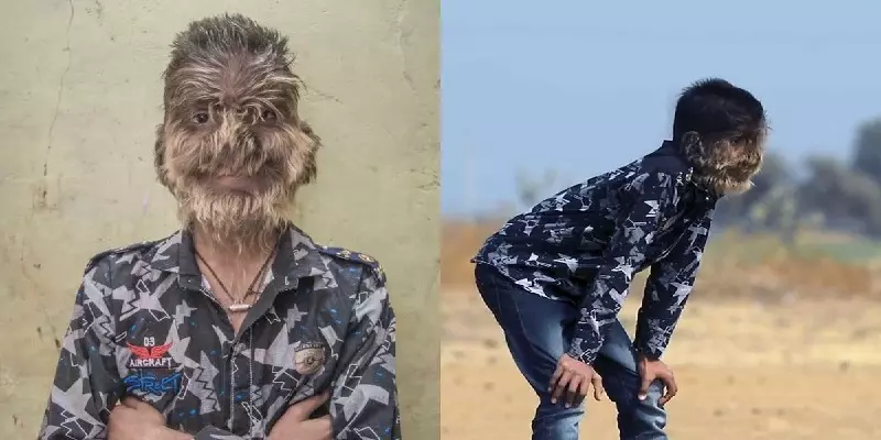 உடல் முழுவதும் வெட்ட வெட்ட வளரும் முடி! அரியவகை நோயால் மீளா துயரத்தில் ம.பி. இளைஞர்!