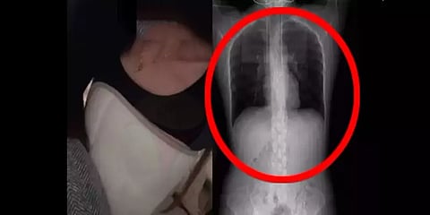 இருமுனதுக்கே எலும்பு முறிவா? - காரமான உணவை சாப்பிட்ட சீனப்பெண்ணுக்கு நடந்த சோகம்