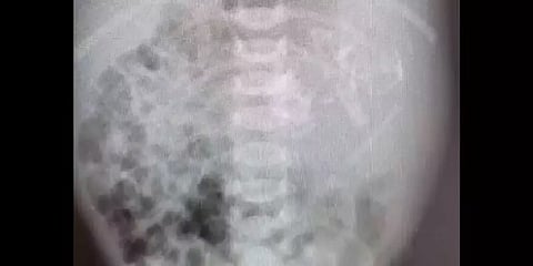 பிறந்த குழந்தையின் வயிற்றுக்குள் இரட்டை கரு - ஸ்கேனை பார்த்து அதிர்ச்சியடைந்த தாய்