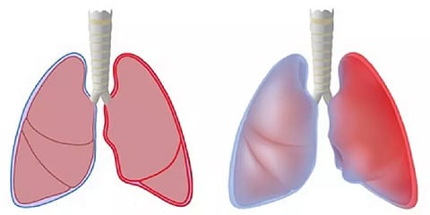 இருமும்போதும், தும்மும்போதும் நெஞ்சு வலிக்கிறதா? - ஈஸியாக எடுத்துக்கொள்ள வேண்டாம்!