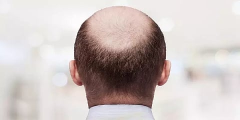 ”வெளிய தலைகாட்ட முடில.. எங்களுக்கும் குடுங்க” - தெலங்கானா வழுக்கை தலை சங்கத்தினர் கோரிக்கை