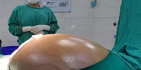22 கிலோ கேன்சர் கட்டியை தொப்பை என நினைத்த பெண் - அகற்றியது எப்படி?