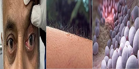 பூதாகரமாய் அச்சுறுத்தும் "பூஞ்சை தொற்றுகள்"... எதிர்கொள்ள மனிதகுலம் தயாரா?