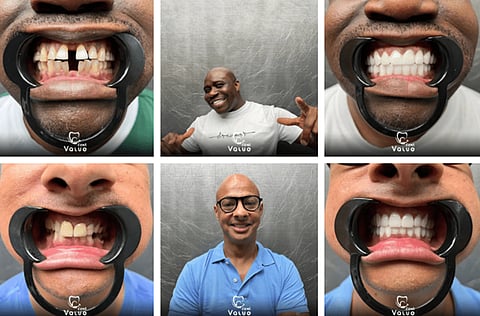 Hollywood Smile in Istanbul: 2025 Price Guide at Valuedent Clinic