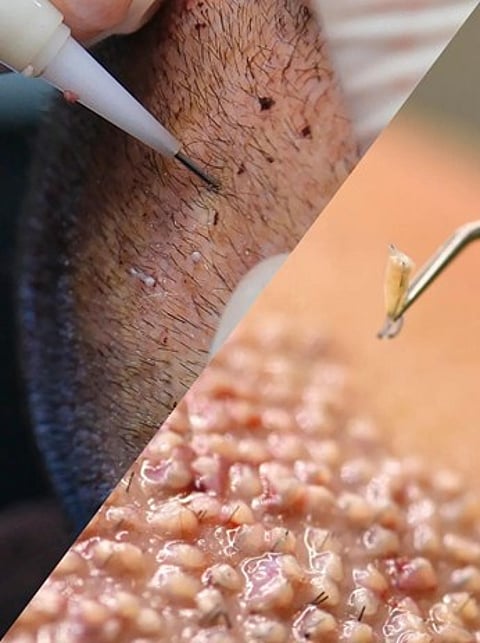 FUE vs. DHI Hair Transplant: Which Method is Right for You?