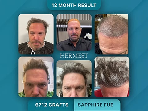 Inside Turkey’s Hair Restoration Boom: Top Clinics, Costs and Advanced Techniques in 2026